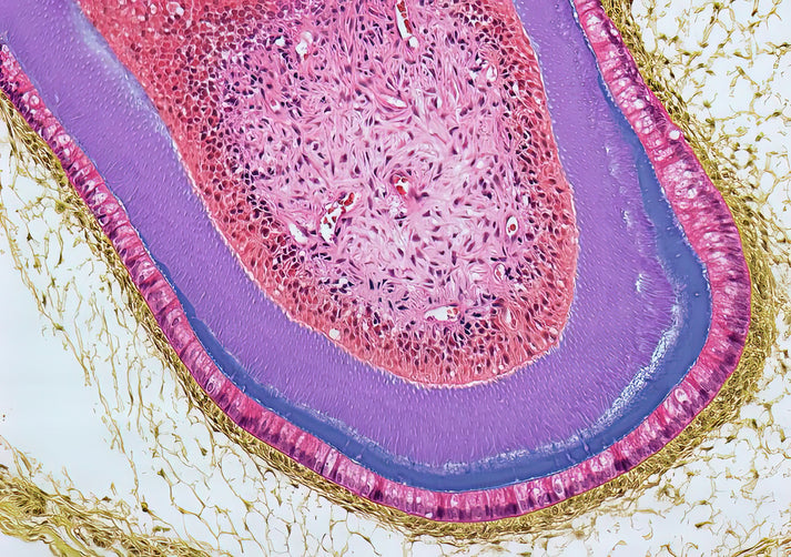Dermoid Ovarian Cyst #5 Art Print | Medical Illustration | RedKalion
