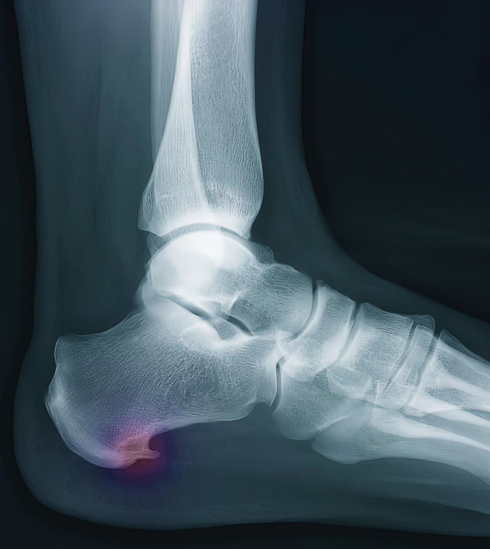 Heel Bone Spur Images: Medical Art Print | RedKalion
