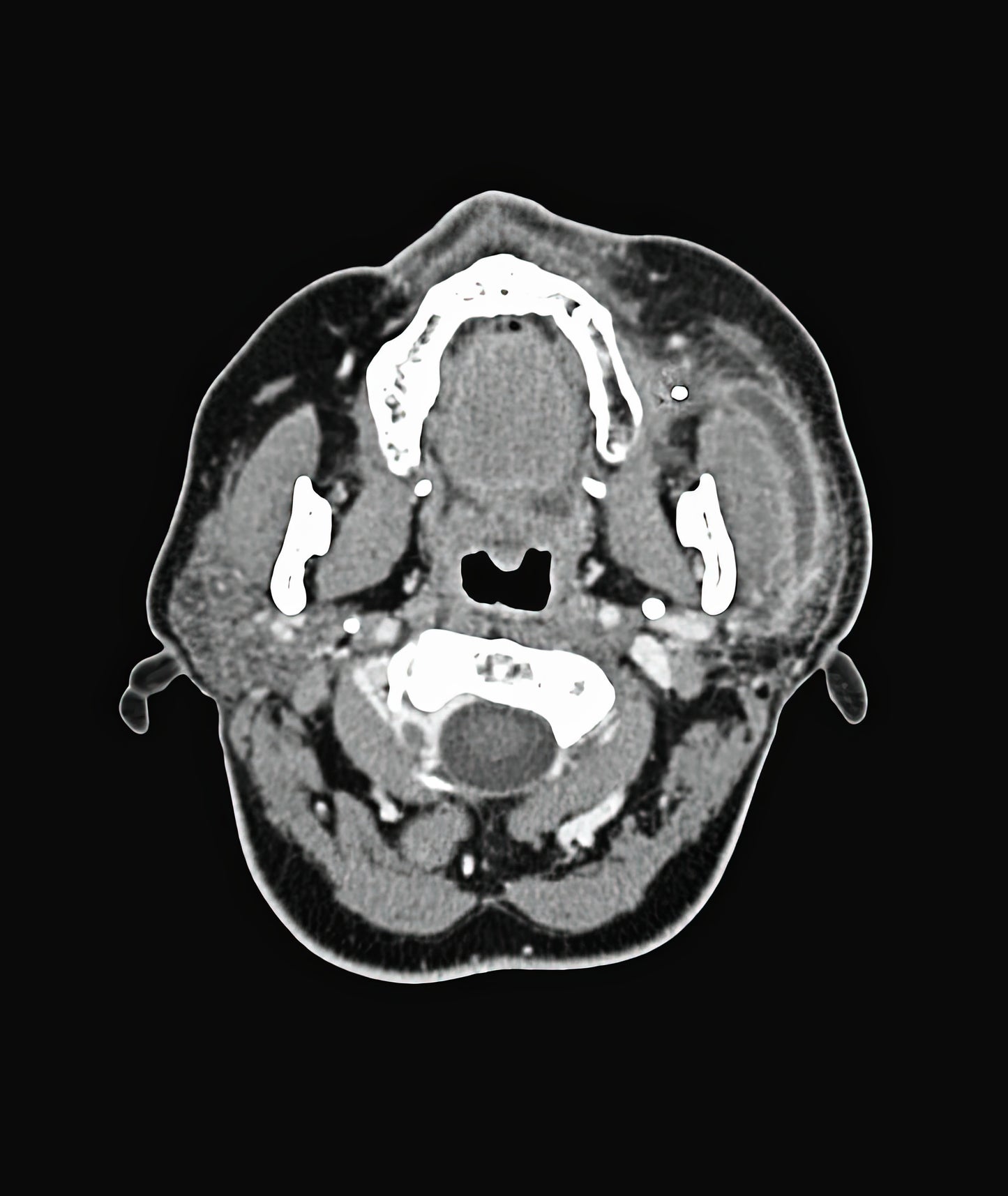 Salivary Gland Stone Pictures: Medical Art Print | RedKalion